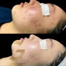 &#34;스타더스트&#34; 흉터, 모공, 여드름 개선의 완벽한 솔루션!