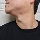 라인핏 | 턱살 볼살 고민 해결 구월동 피부과 인모드 브이라인핏 후기