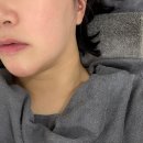 30 | 서면 온다리프팅 6만줄 30대 후기 일주일차 효과