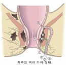 자연치유약국 | 치질(치핵) 완치 리얼 생생 후기(자연 치유 완치)