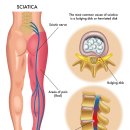 [W166] 허리에서 다리까지 찌릿한 통증, 좌골신경통 (Sciatica) 아닐까요? | Alignlab Chiropractic 이미지