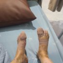 연세건우병원 | 내성발톱 수면마취 국소마취 수술 후기