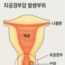 자궁경부암 백신 부작용 이미지