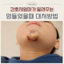 멍플러 | 아기 얼굴 멍 연고 멍들었을때 대처방법