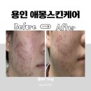 수지피부관리 [애몽스킨케어] / 1:1 맞춤 여드름 관리, 여드름 요철 5일 만에 박멸한 후기(비포에프터)