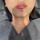목동피부과 목주름필러 오마쥬넥 1회차 시술 내돈내산 후기(효과 가격 통증)