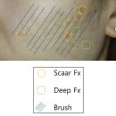 메디펄스 | 울트라펄스알파 여드름흉터 치료 완전정리_스카Fx vs 딥Fx vs CPG 모드 차이와 실제 사용법