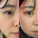 베이스피부과의원 | 바노바기의원 창원 피부과 셀엑소좀 내돈내산 피부관리 효과 및 통증 후기