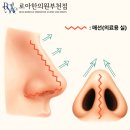 코필러후기 내돈내산, 이것만 믿고 했다가 후회한 이유