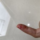 칼에베어 살점 떨어진 상처 듀오덤