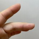 말벌에 쏘였을때
