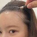 오늘은 헤어 | 여자 모발이식 상담 후기 헤어라인교정 비절개히든컷 (디자인, 가격)