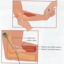 정통추나치료 - 테니스엘보우(Tennis elbow) - 물리추나학회 이미지