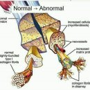 테니스 엘보(lateral epicondylitis) 문헌고찰 이미지