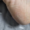 봉화약국 | [노원] 내성발톱, 무좀 관리는 풋스올 (재방문 후기)