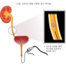 첫번째키친 | 30대 여자의 신장결석 투병기🥲 #3 - 요관내시경 첫번째 수술 후기