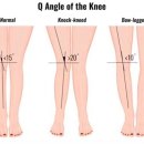 금강프라자 앞(주부토로 223) | X자 다리? 교정가능할까? : 외반슬, genu valgum [인천필라테스, 부평필라테스, 기구필라테스, 재활...