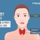 갑상선기능항진증 원인 증상 치료 그레이브스병 항갑상선제 이미지