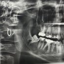 담덕치과의원 | 사랑니 발치 후기 2