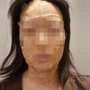 보드미 | 편평사마귀 성지 연세보드미의원 솔직후기