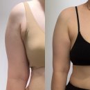 나주사 | 수원 팔 지방추출주사후기 상체다이어트 시작(멍, 부작용)