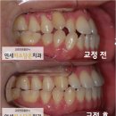 서울미소담은치과의원 | 덧니(반대교합) 비발치 교정_성동구 행당동 금호동 연세미소담은교정치과