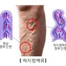 하지정맥류 Varicose Veins 이미지