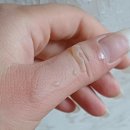 엄지약국 | 엄지손가락 화상 심재성2도 치료후기, 화상치료비 보상(1)