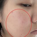압구정 - 진주시 진주대로 901 | 압구정 피부과_슈링크 후기!! 통증 없어서 깜놀했어요 ><