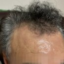 M병원 | 서면탈모병원추천 60대 M자탈모 6개월차 내돈내산솔직후기