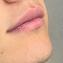 유(U)스타일9의원 | 강남역 남자 수염 레이저 제모 유스타일9의원 비포애프터 후기 3회차