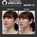 뉴페이스 | 해운대 얼굴 비대칭과 안면윤곽을 한 번에 잡아주는 [뉴페이스바디] 후기