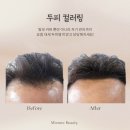 대구 탈모 유형과 두피컬러링으로 극복한 사례