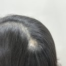 투쓰리 헤어라인 이미지