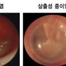 귀가 먹먹할때 및 한쪽 귀 먹먹 원인 이미지