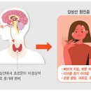 갑상선 기능 항진증 증상 수치 나쁜 음식은? 이미지