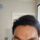 화접몽한의원 | 화접몽한의원 강서목동점 편평사마귀,검버섯,쥐젖 제거 한달차 !