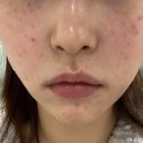 리즈멍 | 피부과 리쥬란vs리즈네 4cc 스킨부스터 내돈내산 후기(통증/엠보/효과/멍) 미미썸의원 김해