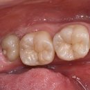 디어스치과의원 | 천호동치과 사랑니 통증, 붓기와 염증 반복된다면 지금 확인해야 합니다