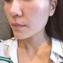 하이300 | [신논현피부과 후기] 강남 덴서티하이 300샷 리프팅 내돈내산 효과 가격 전후