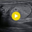 thyroid adenoma 갑상선 선종 이미지