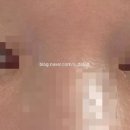 아그네스뷰티 | [한관종] 아그네스 시술 후기(1차)