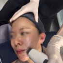 sunny+(써니플러스) | 울쎄라, 인모드 말고 진짜는 써니리프팅? 의정부 써니리프팅 리얼후기