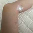 [하지정맥류] 고주파 정맥 폐쇄술 | 수술 후기, 당일 입퇴원, 비급여 실비보험청구, 수술 경과 등