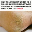 '발뒤꿈치 굳은살,갈라짐! 발뒤꿈치 각화증' 이미지