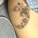 홍대디온의원 | [타투/문신제거] 검정타투 지우기 : 1-5회차/내돈내산/(홍대 문신, 타투제거)