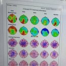 이지브레인정신건강의학과의원 | deepTMS치료 후기 뇌파변화 (불면 우울치료)뇌파검사