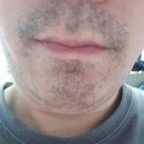 리센트의원 | 젠틀맥스프로 남자 얼굴전체 제모 후기 1차 서울 리센트 클리닉