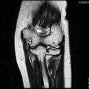 Re:elbow mri 이미지