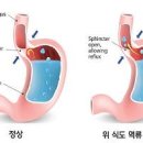 역류성 식도염 원인과 증상 가래 신물 올라올 때 목이 따가워요~ 약 좋은 음식 이미지